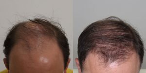 کربوکسی تراپی مو - کلینیک تندیس