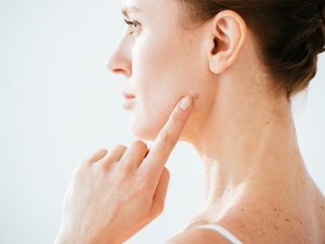 برداشتن خال با پلاسما - کلینیک تندیس