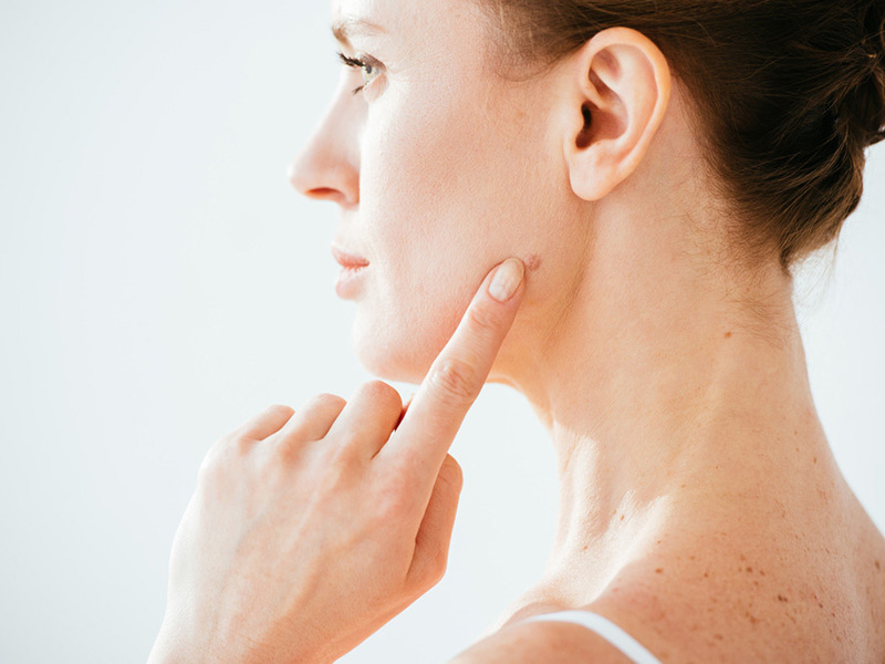 برداشتن خال با پلاسما - کلینیک تندیس