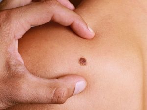 برداشتن خال با پلکسر - کلینیک تندیس