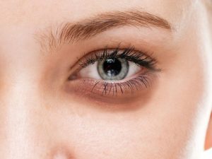 رفع گودی پلک - کلینیک تندیس