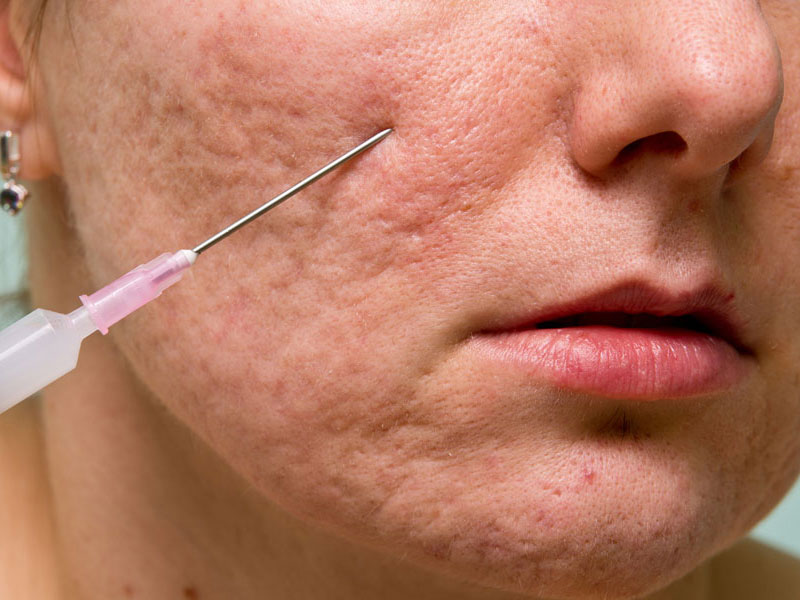 مزایای استفاده از سابسیژن - کلینیک تندیس