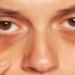 سیاهی زیر و دور چشم - کلینیک تندیس