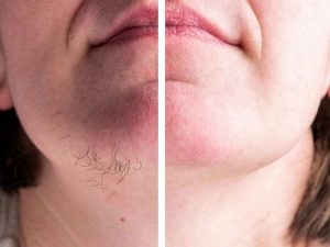 اختلال هورمونی در لیزر موهای زائد - کلینیک تندیس