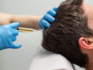 روش های کاشت مو - کلینیک تندیس