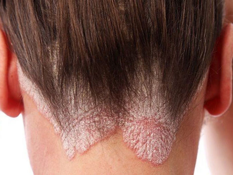 لیزر موهای زاید بیماران پسوریازیس - کلینیک تندیس