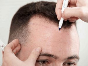 نقاهت بعد از کاشت مو - کلینیک تندیس