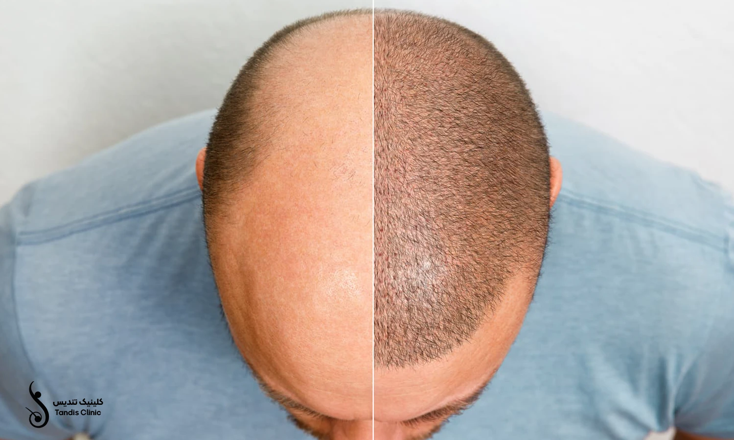 قبل و بعد از کاشت مو سر آقایان