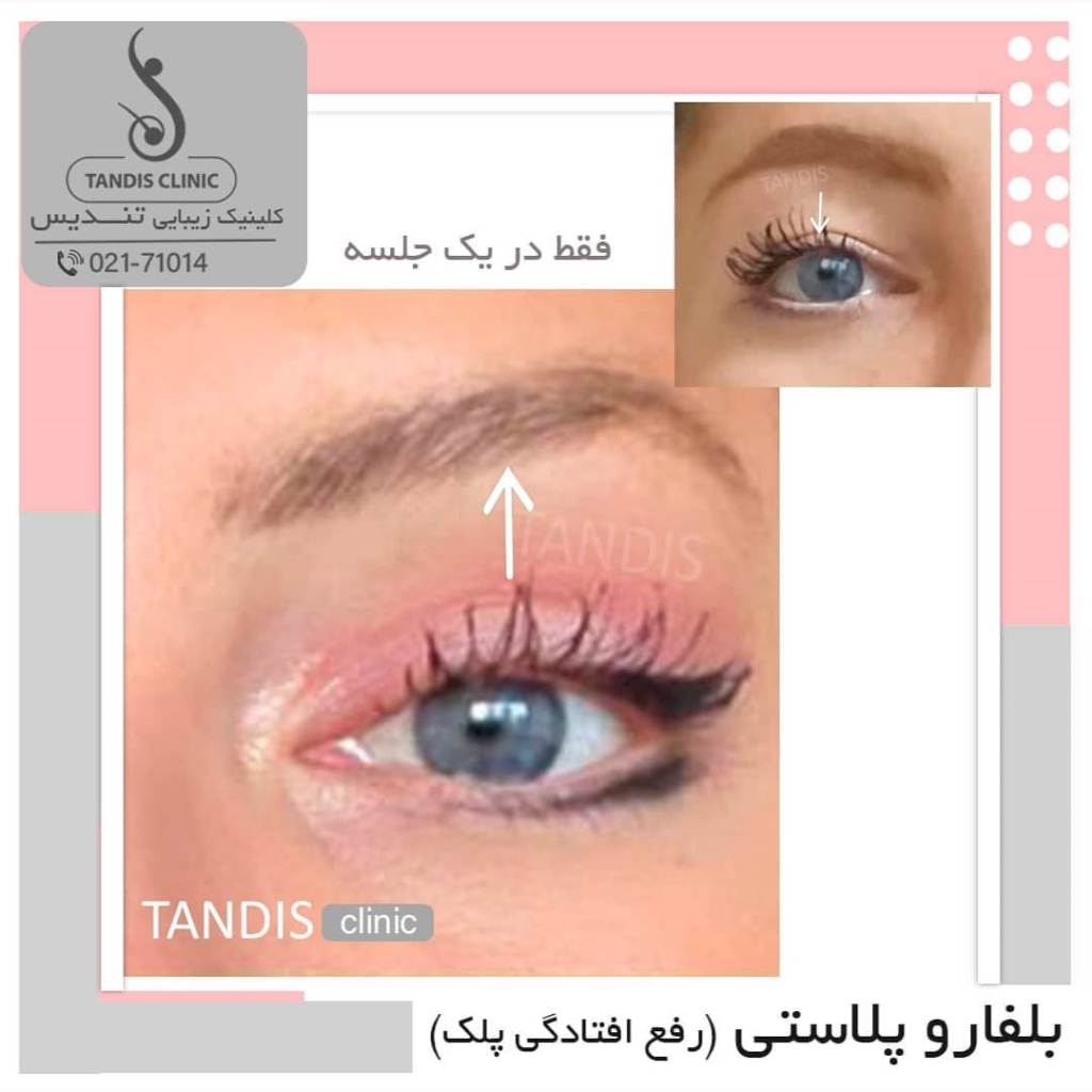 نمونه کار بلفاروپلاستی