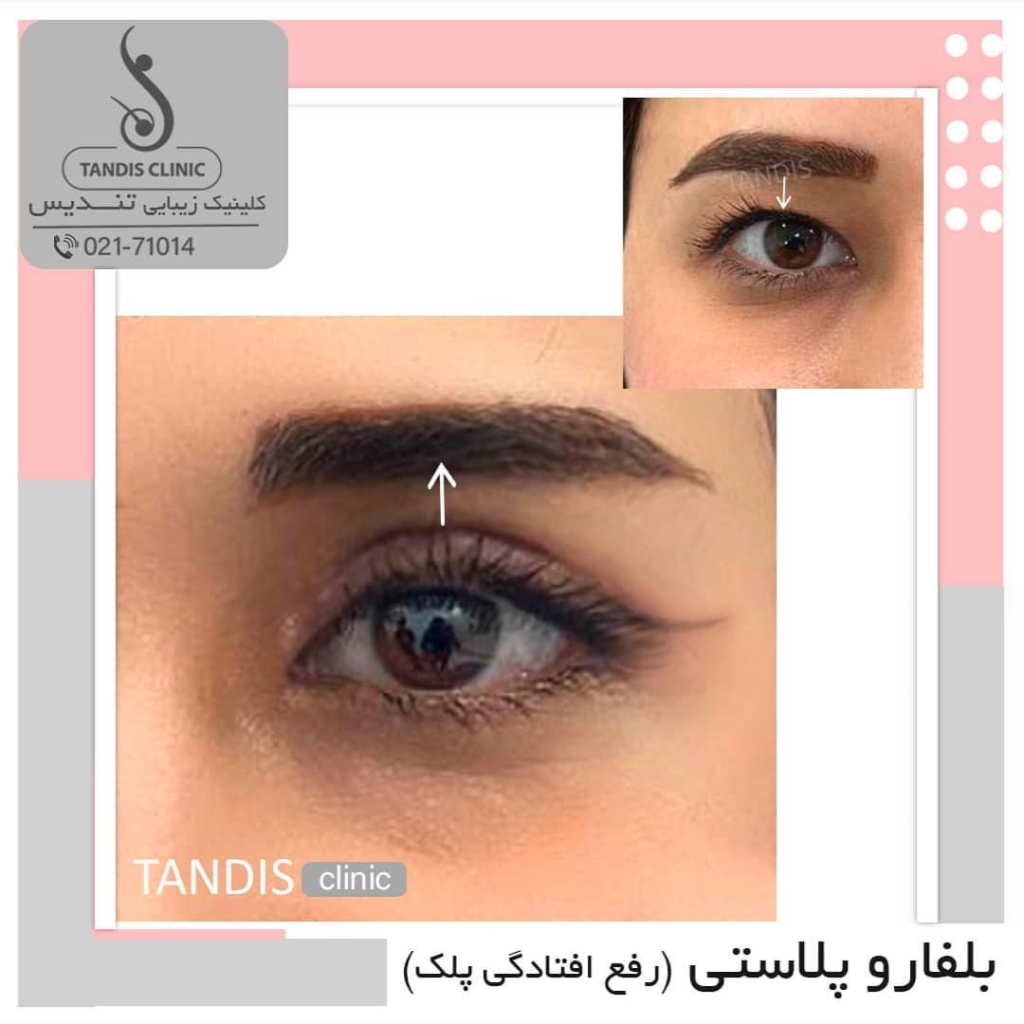 نمونه کار بلفاروپلاستی