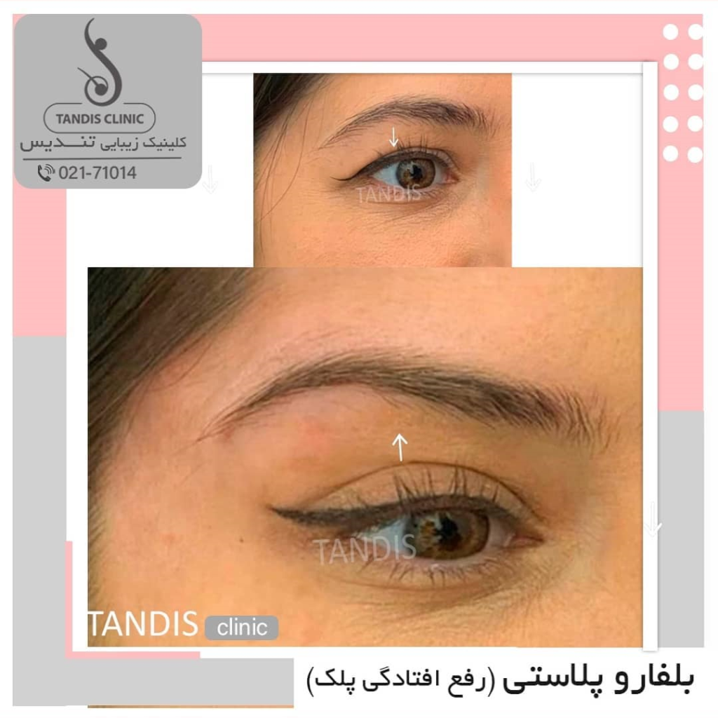 نمونه کار بلفاروپلاستی