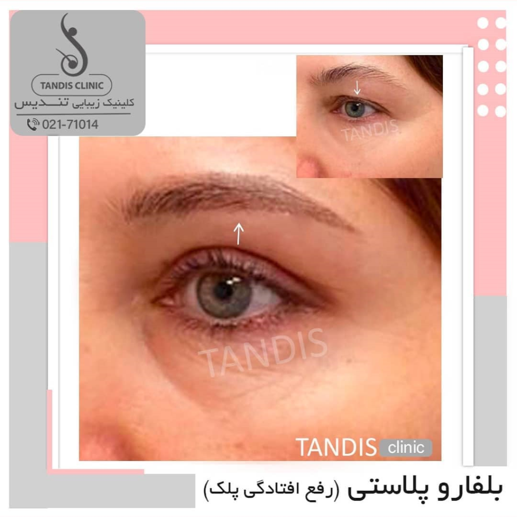 نمونه کار بلفاروپلاستی