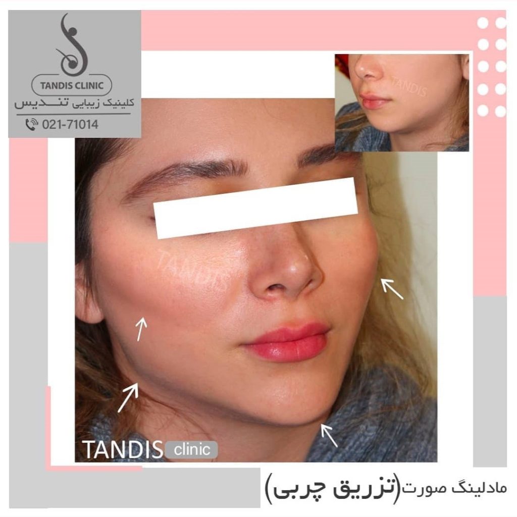 نمونه کار تزریق چربی