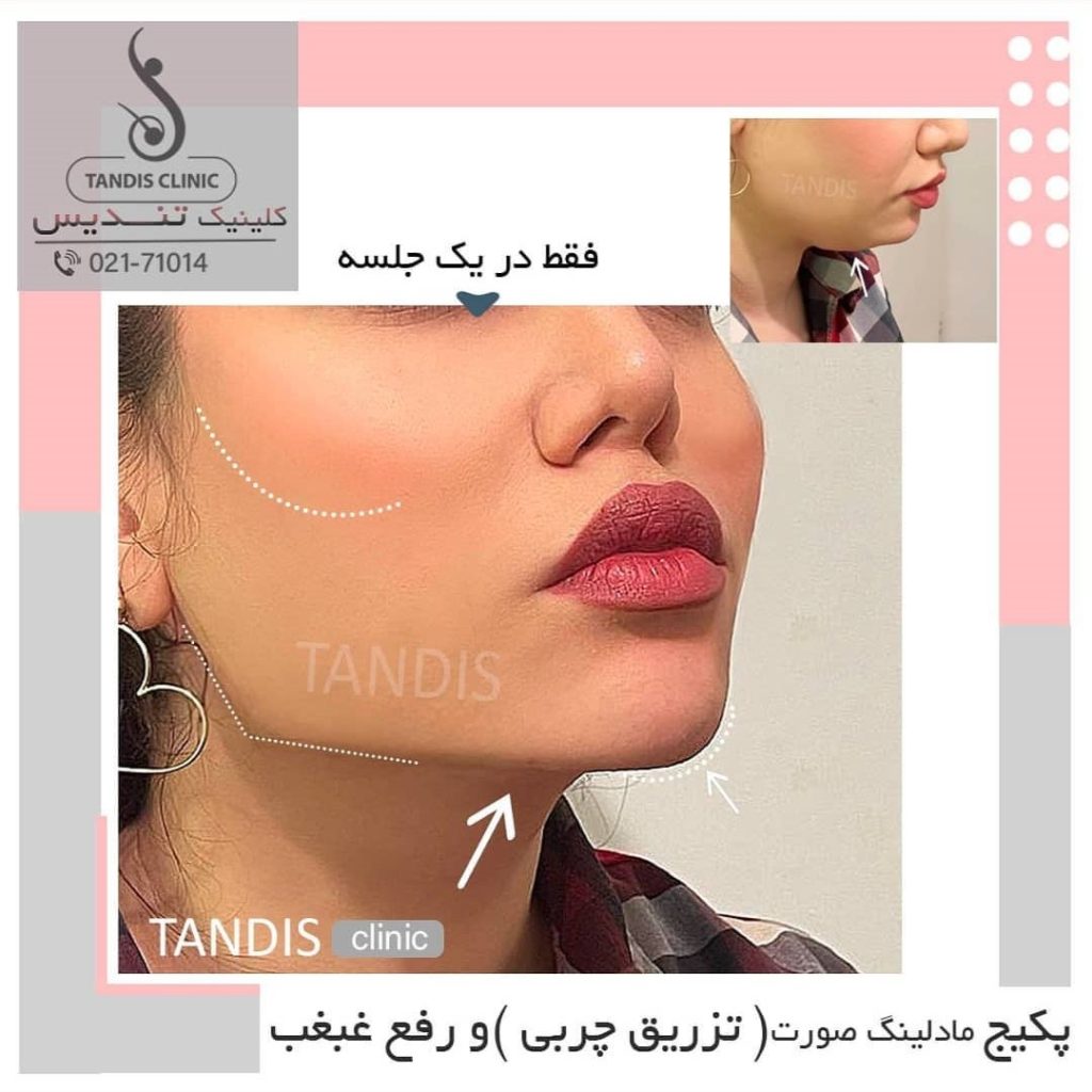 نمونه کار تزریق چربی