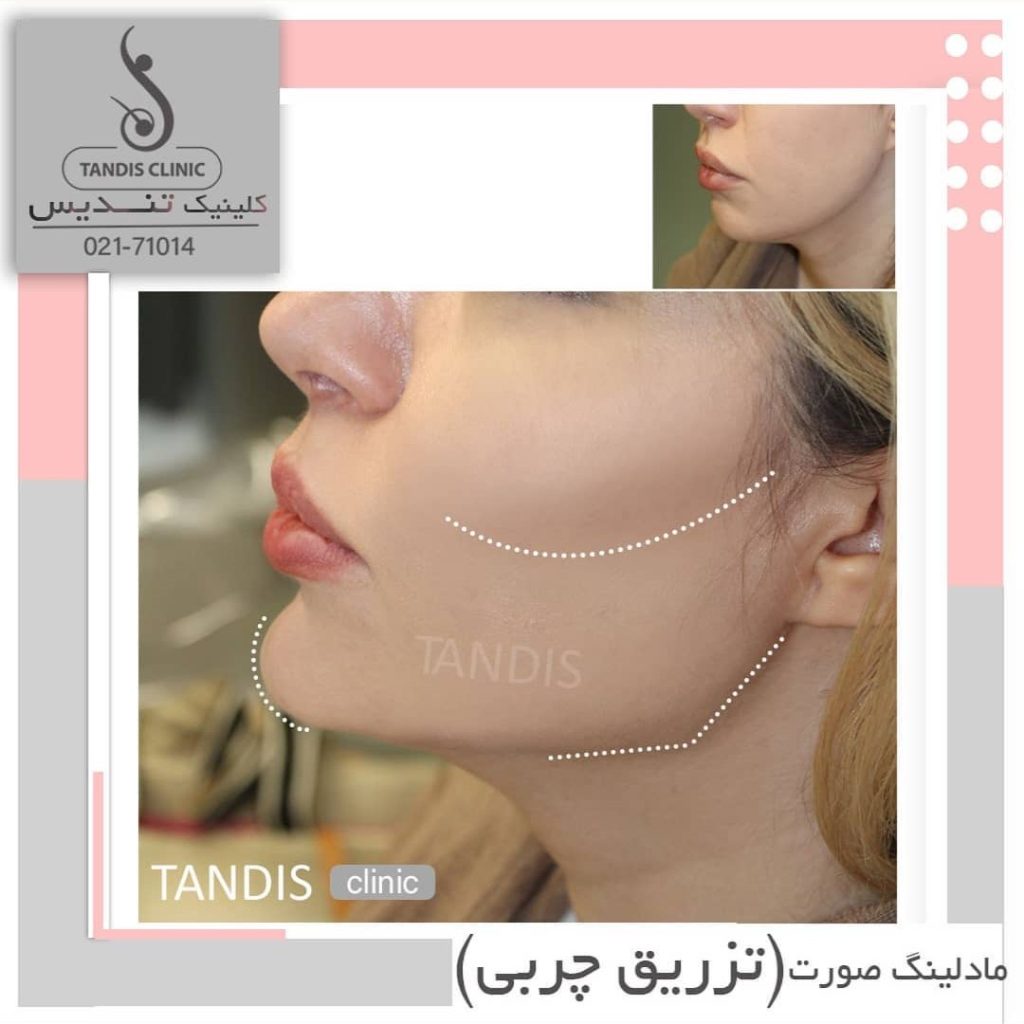 نمونه کار تزریق چربی