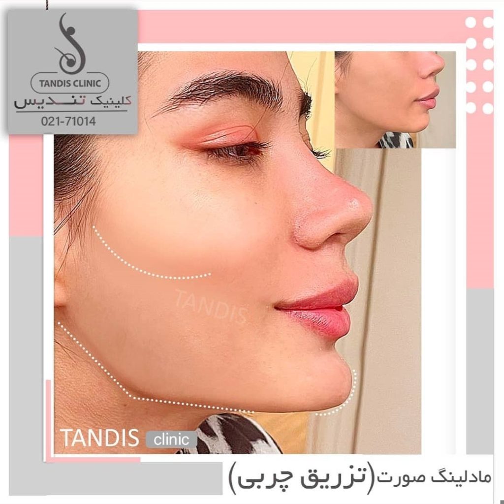 نمونه کار تزریق چربی