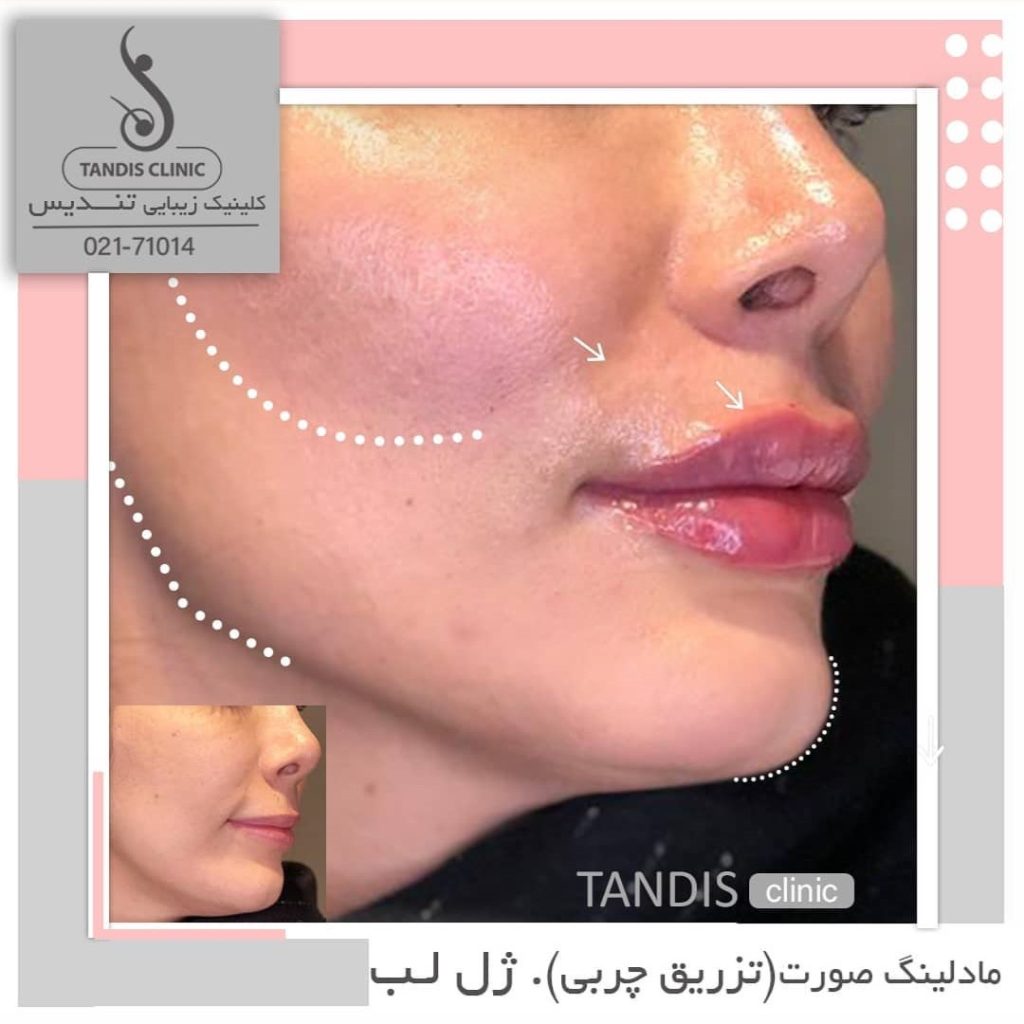 نمونه کار تزریق چربی