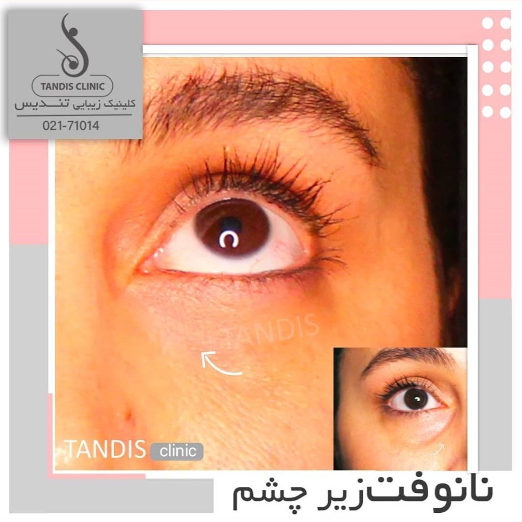 نمونه کار تزریق چربی