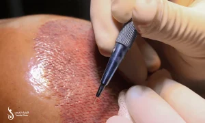 کاشت ابرو به روش fue