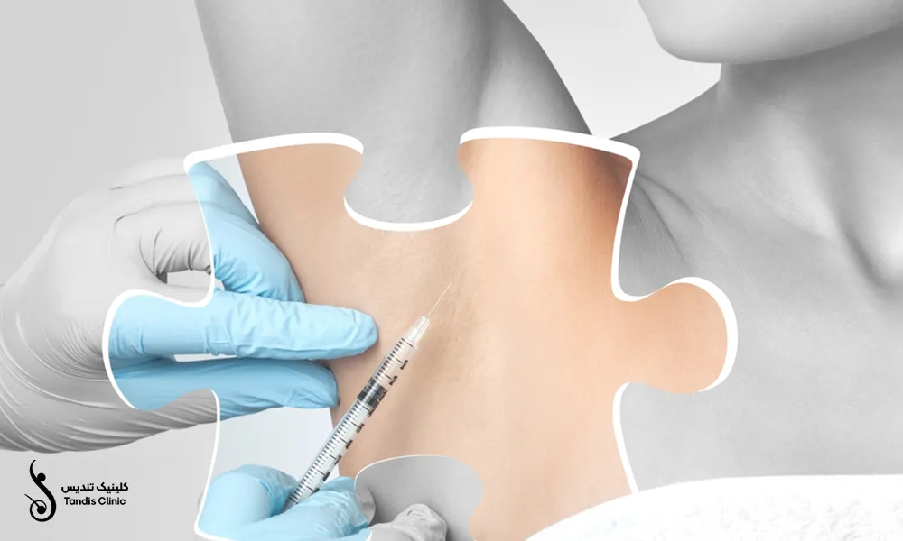 تزریق بوتاکس به زیر بغل یک خانم برای درمان تعریق