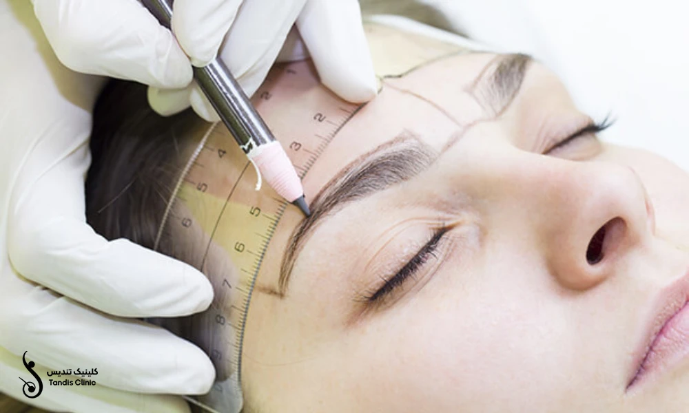 انجام خط کشی های قبل از کاشت ابرو | مقایسه میکروبلیدینگ با کاشت ابرو
