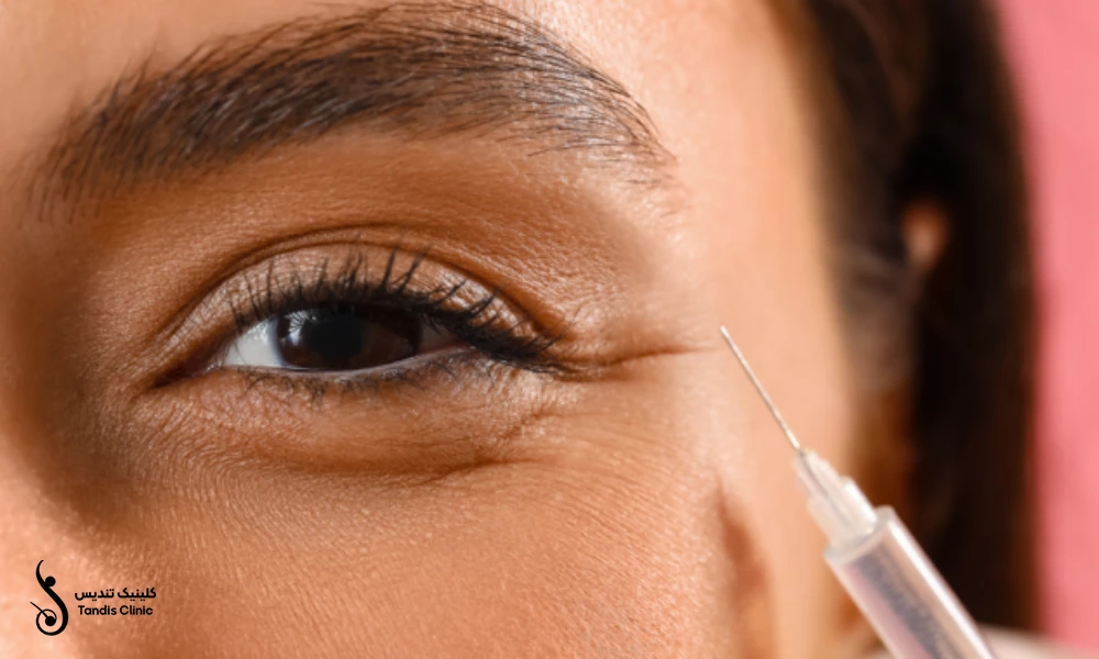 خانمی در حال انجام تزریق فیلر زیر چشم
