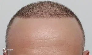 نتیجه ی انجام کاشت مو به روش FUT