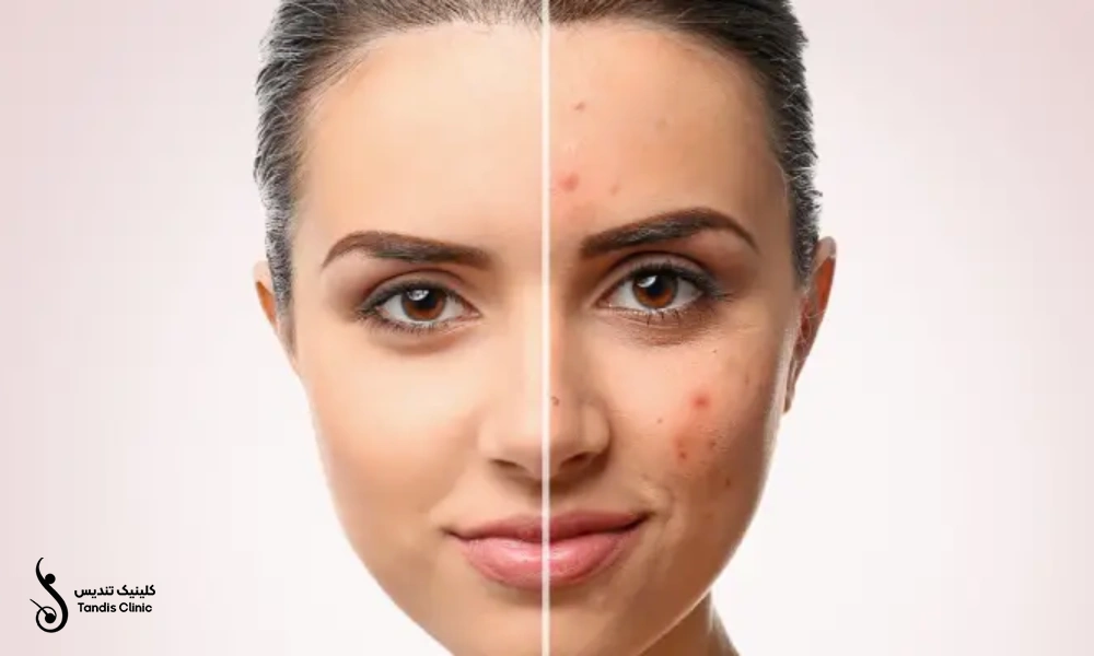 قبل و بعد درمان سابسیژن صورت