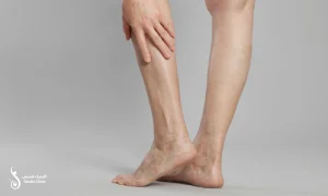 درمان واریس