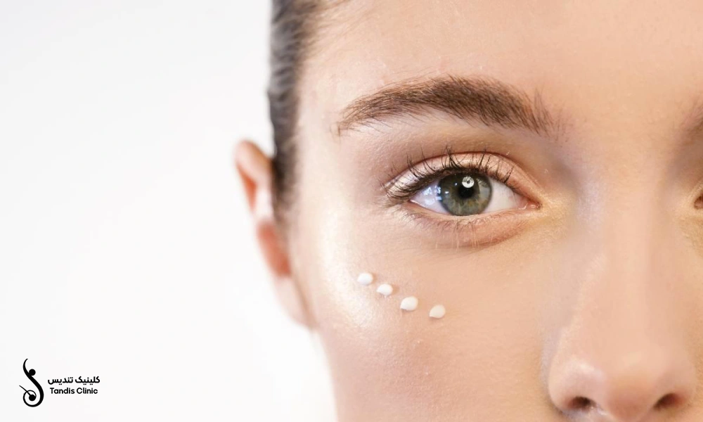 نقاط تزریق مزوژل و فیلر زیر چشم