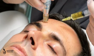 میکرونیدلینگ پیشانی یک آقا