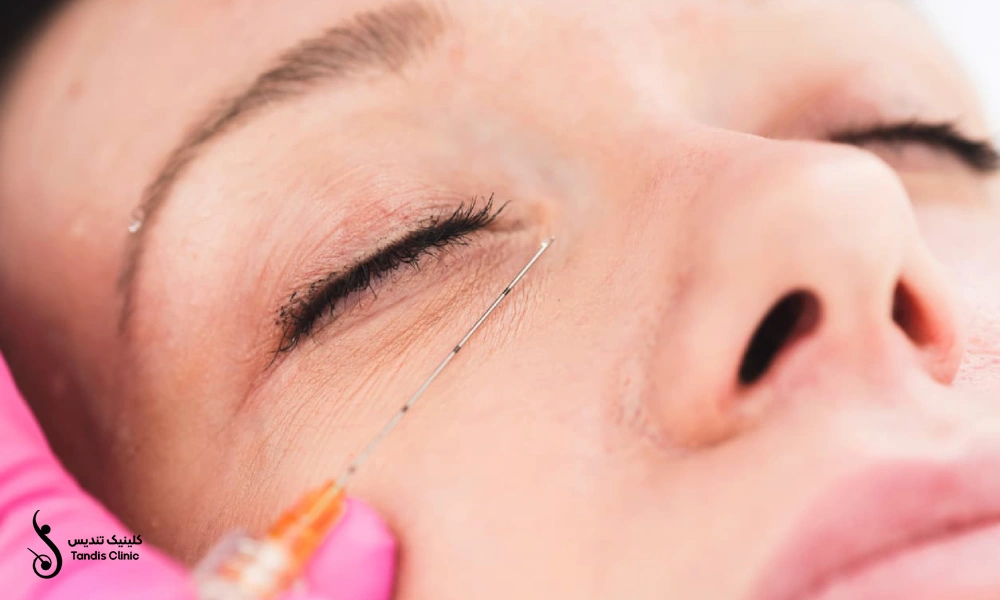 تزریق مزوژل جوانساز زیرچشم