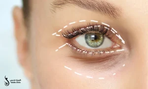 ترسیم خطوط عمل بلفاروپلاستی برروی پلک یک بیمار خانم