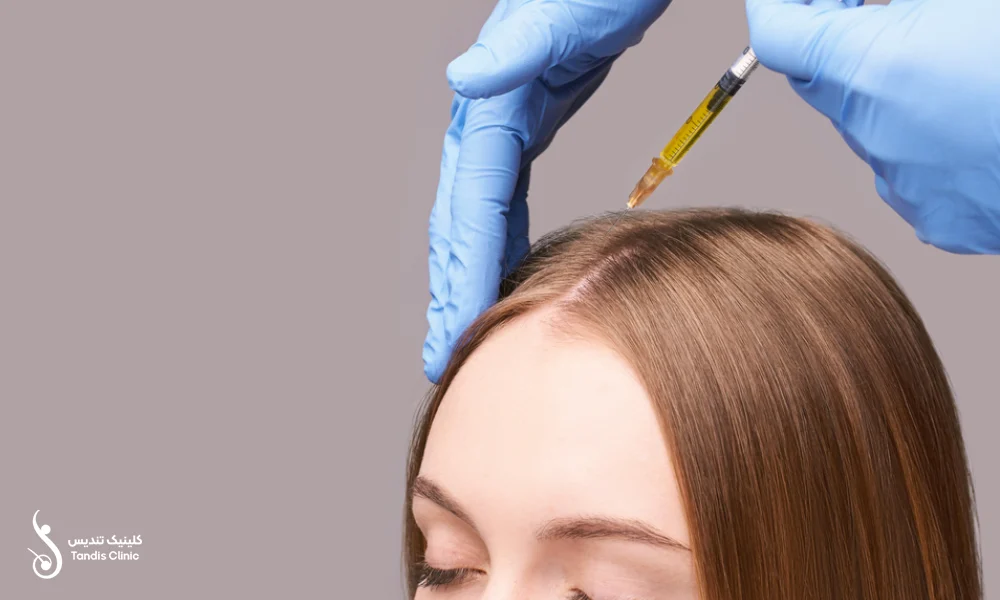 تزریق مزوتراپی به فرق سر یک خانم برای تقویت مو