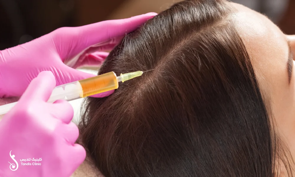 تزریق مزوتراپی به سر یک خانم که دچار ریزش مو است