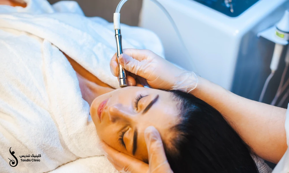 میکرودرم روی صورت یک زیباجو خانم