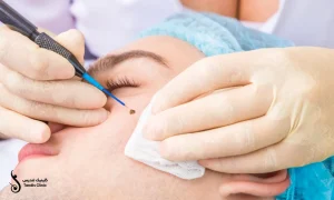 برداشتن خال از روی صورت یک خانم