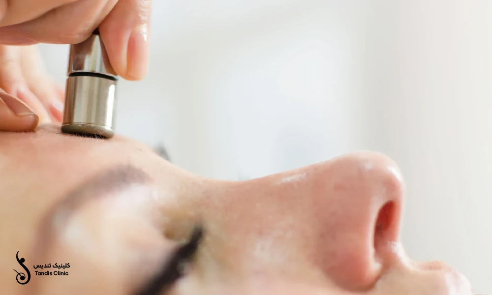 انجام میکرودرم بر روی پیشانی یک خانم
