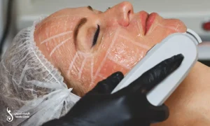 انجام هایفوتراپی صورت یک خانم