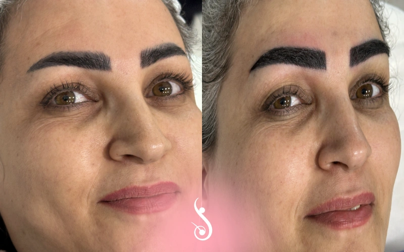 کاشت ابرو قبل و بعد