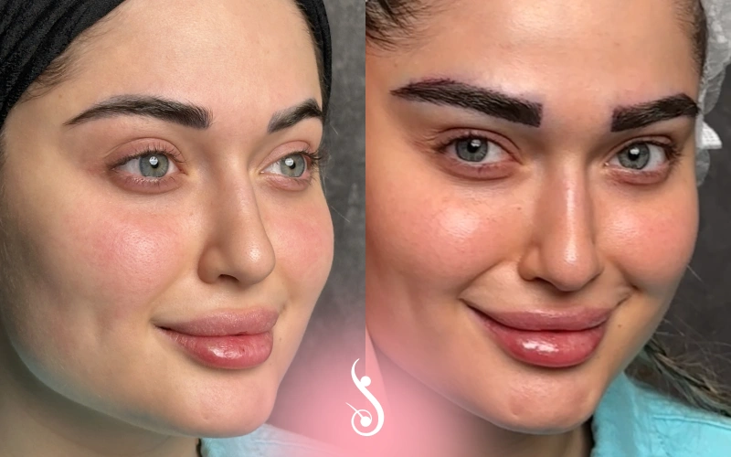 کاشت ابرو قبل و بعد