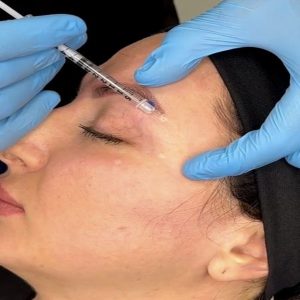 بوتاکس ابرو چیست؛ فواید، مزایا و عوارض