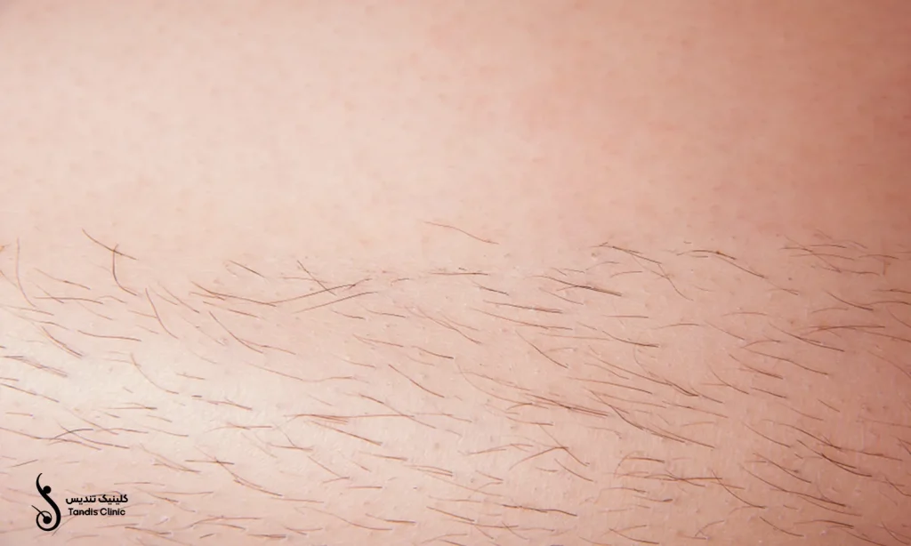 موهای زائد یک خانم قبل از لیزر بیکینی