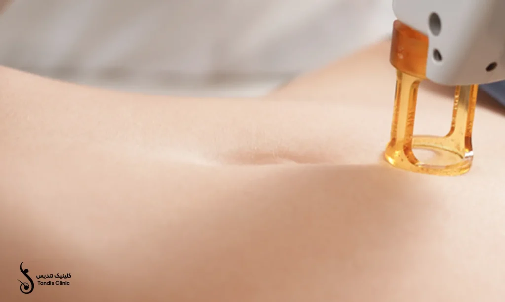 اپراتور در حال لیزر کردن نواحی اطراف بیکینی