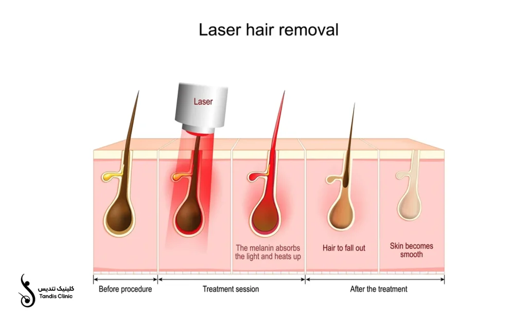 نحوه عملکرد لیزر موهای زائد بیکینی