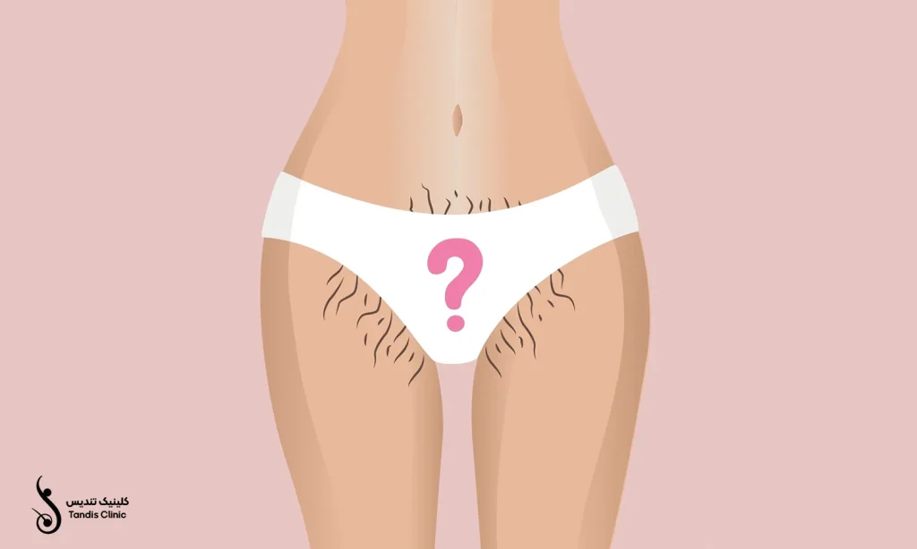 ترسیم گرافیکی موهای زائد بیکینی 