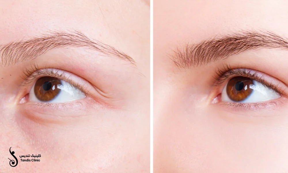 نتیجه کاشت ابرو به روش FUE