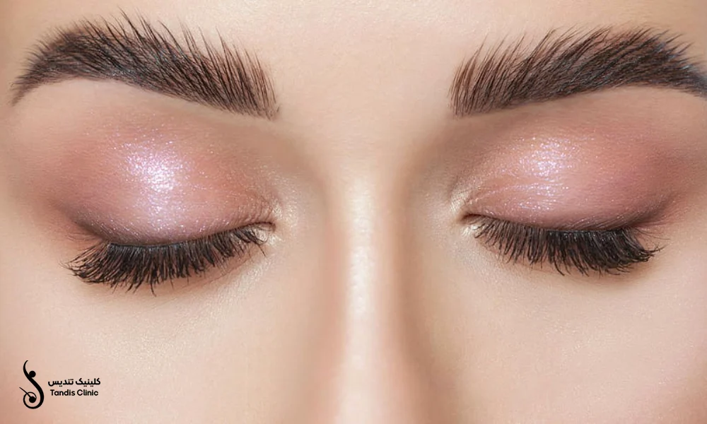 تاثیرات کاشت ابرو به روش SUT روی صورت دختران