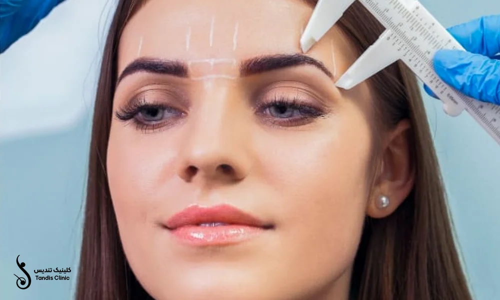 قرینه سازی ابرو قبل از کاشت ابرو به روش FUE