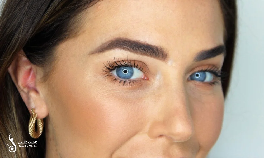 تغییرات ظاهری بعد از کاشت ابرو به روش SUT